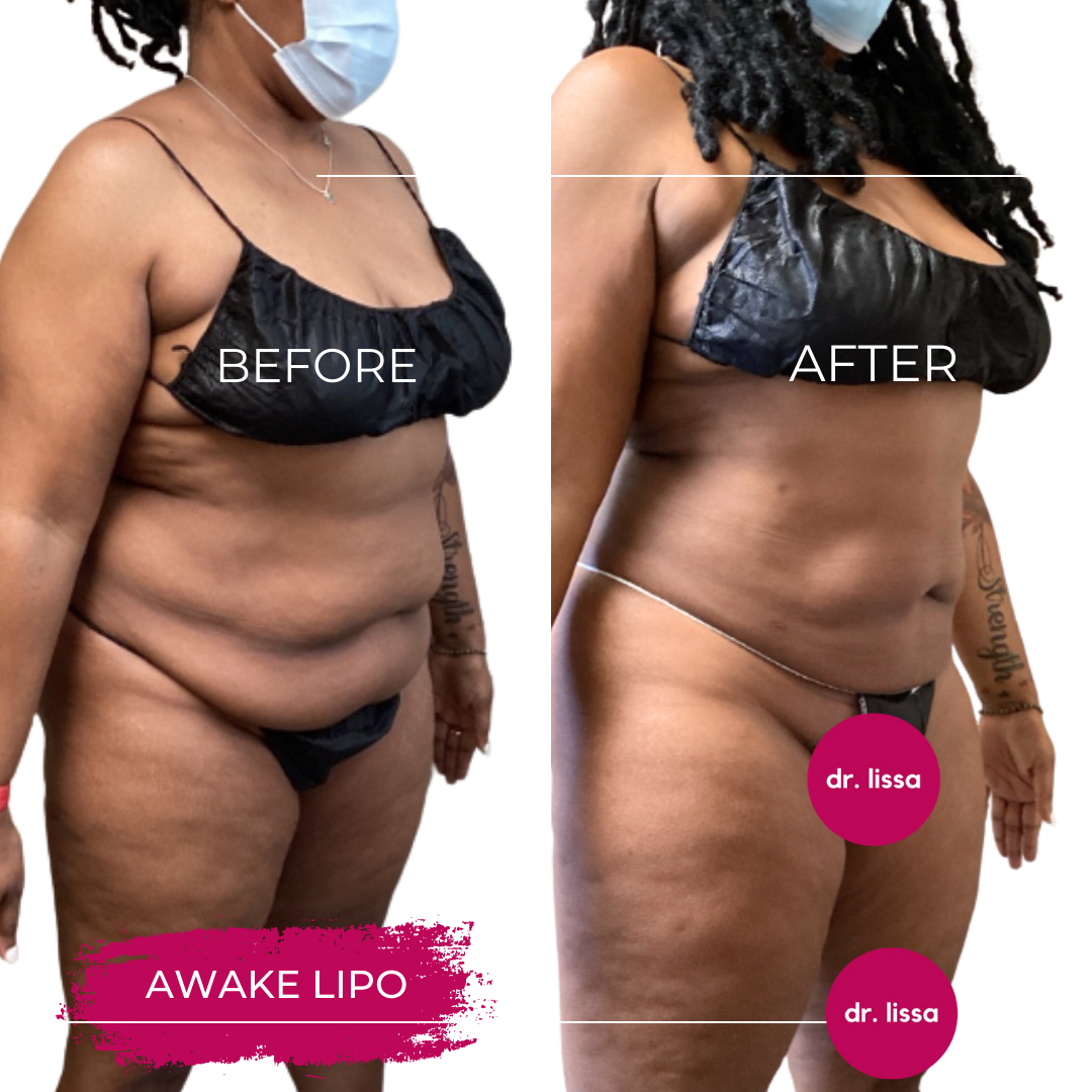 High-BMI-Case4-Awake Lipo