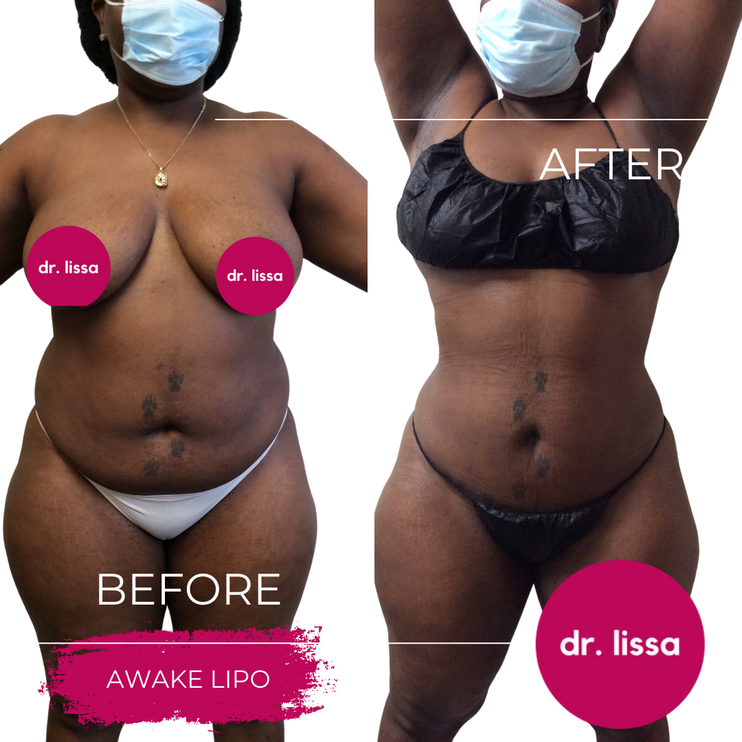 High-BMI-Case5-Awake lipo(10)