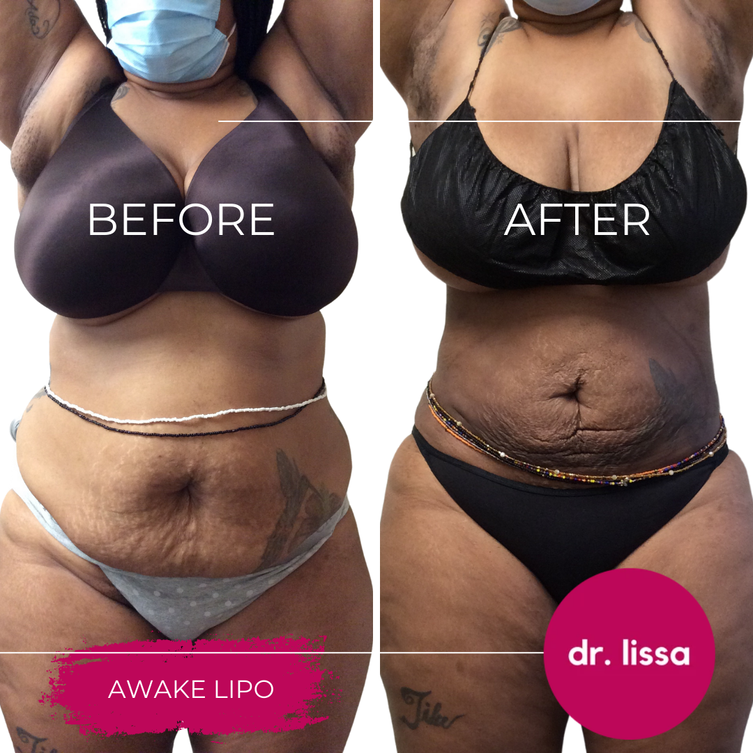 High-BMI-Case6-Awake Lipo(9)