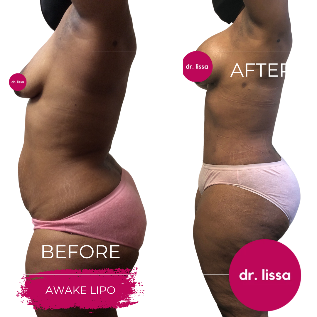 High-BMI-Case7-Awake Lipo(8)