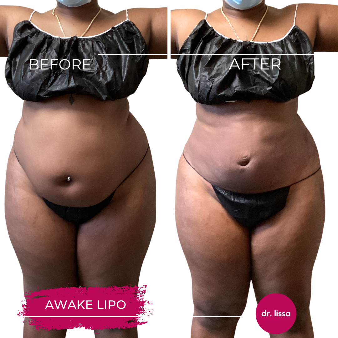 High-BMI-Case8-Awake Lipo(7)