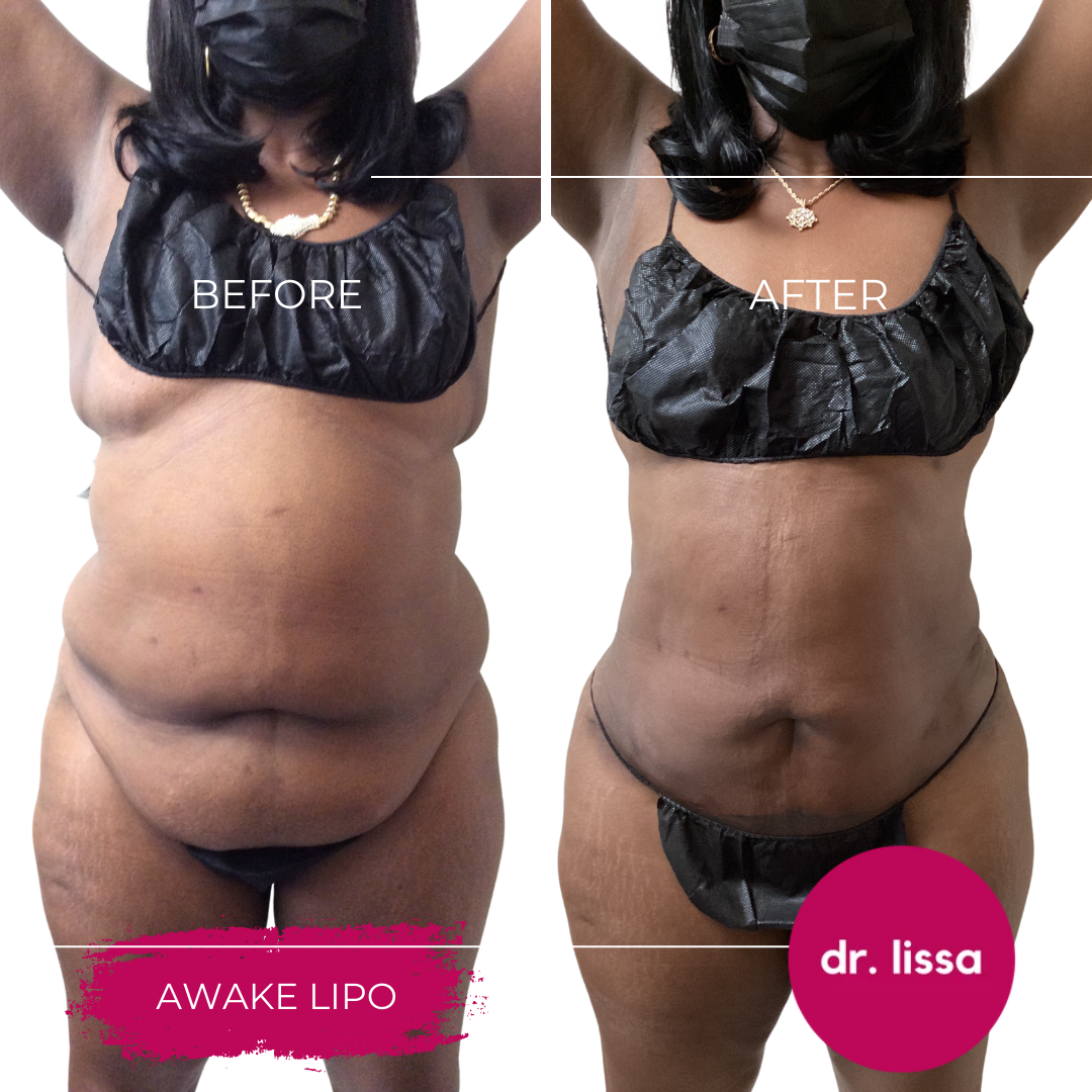 High-BMI-Case9-Awake lipo(6)