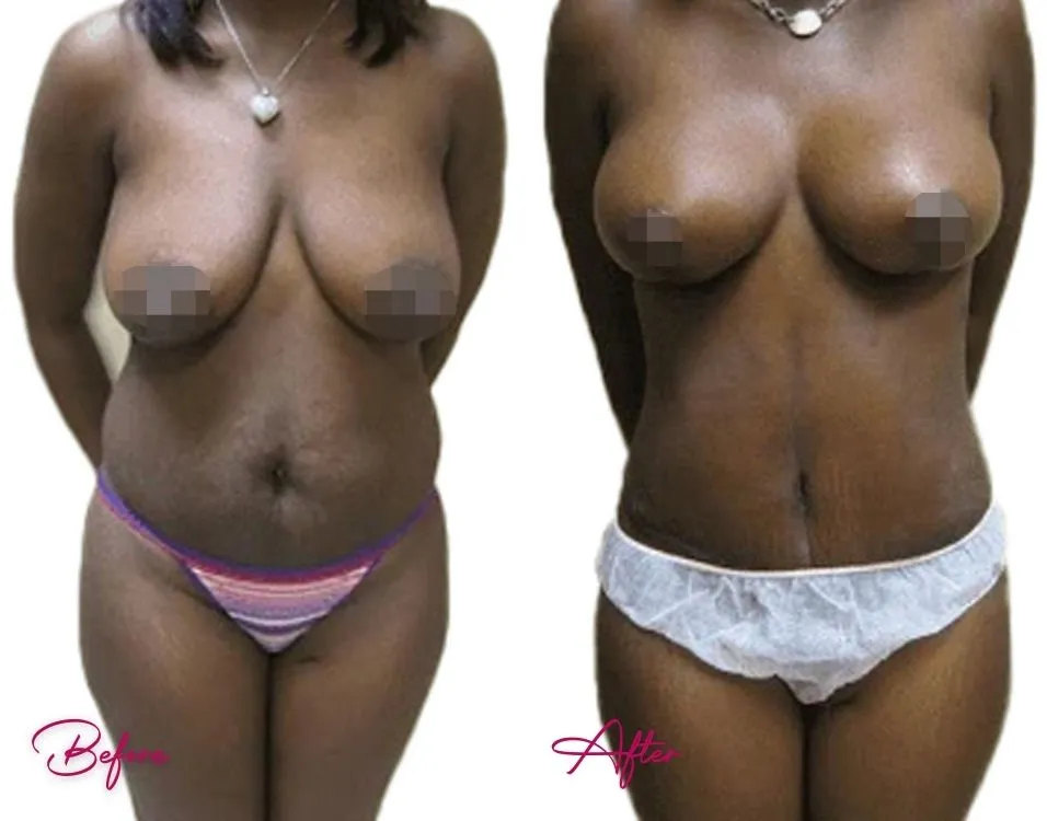 Tummy Tuck - Case 10.1