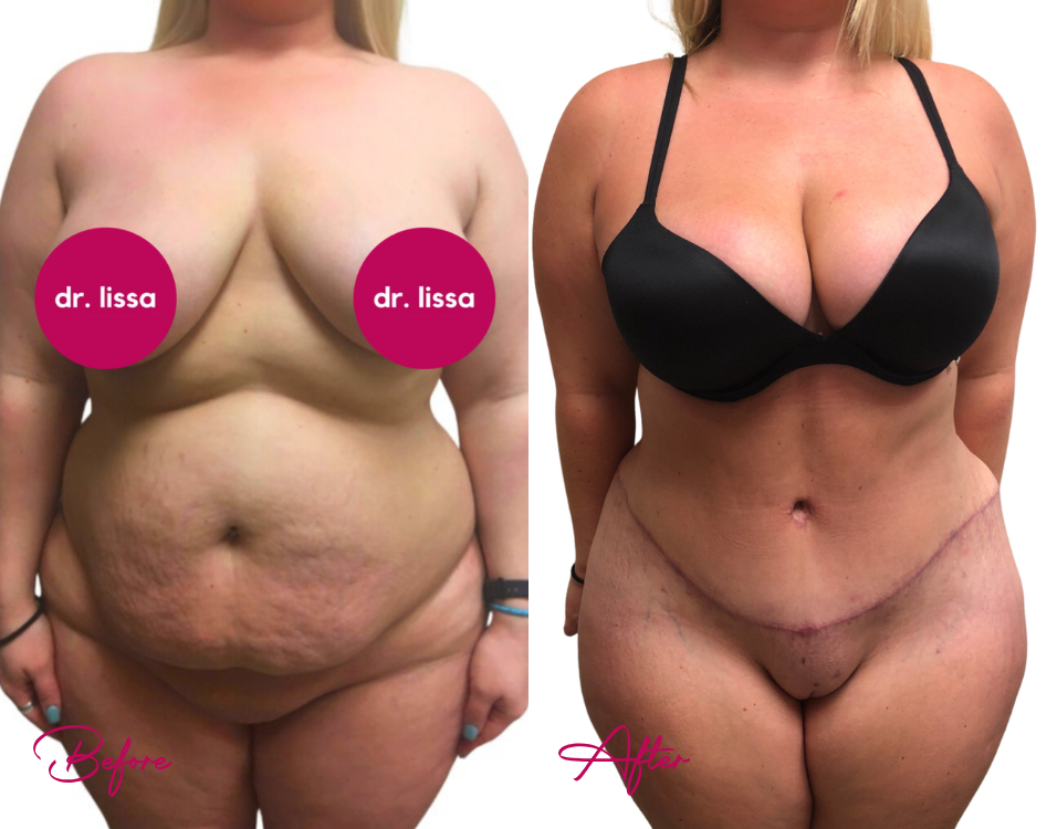 Tummy Tuck Case 21-2