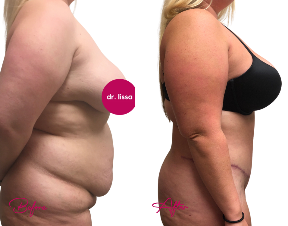 Tummy Tuck Case 21