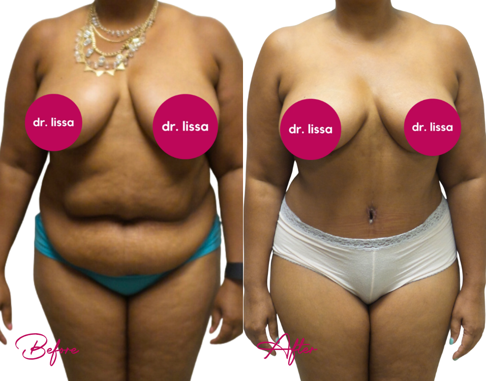 Tummy Tuck Case 22