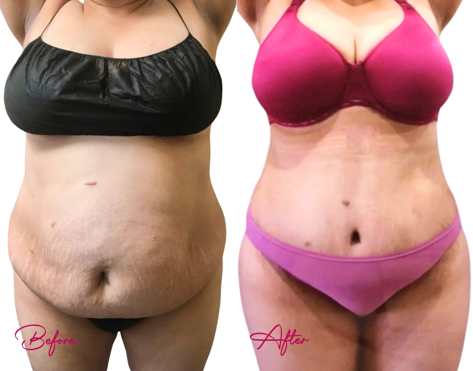 Tummy Tuck Case 23