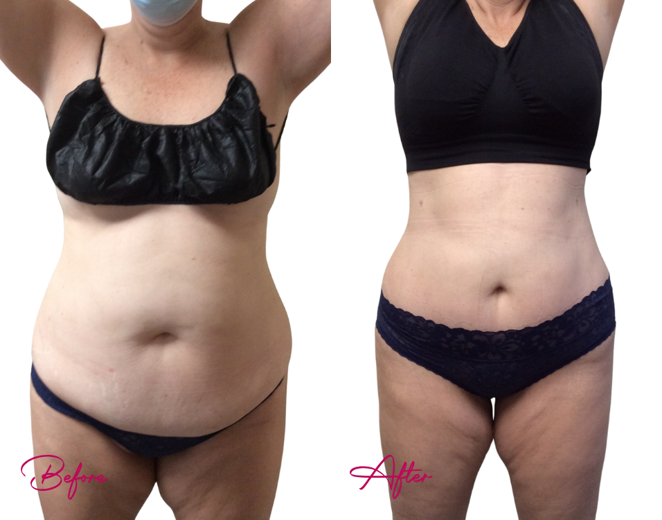 Tummy Tuck Case 24