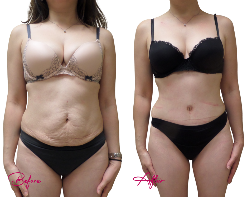 Tummy Tuck Case 25
