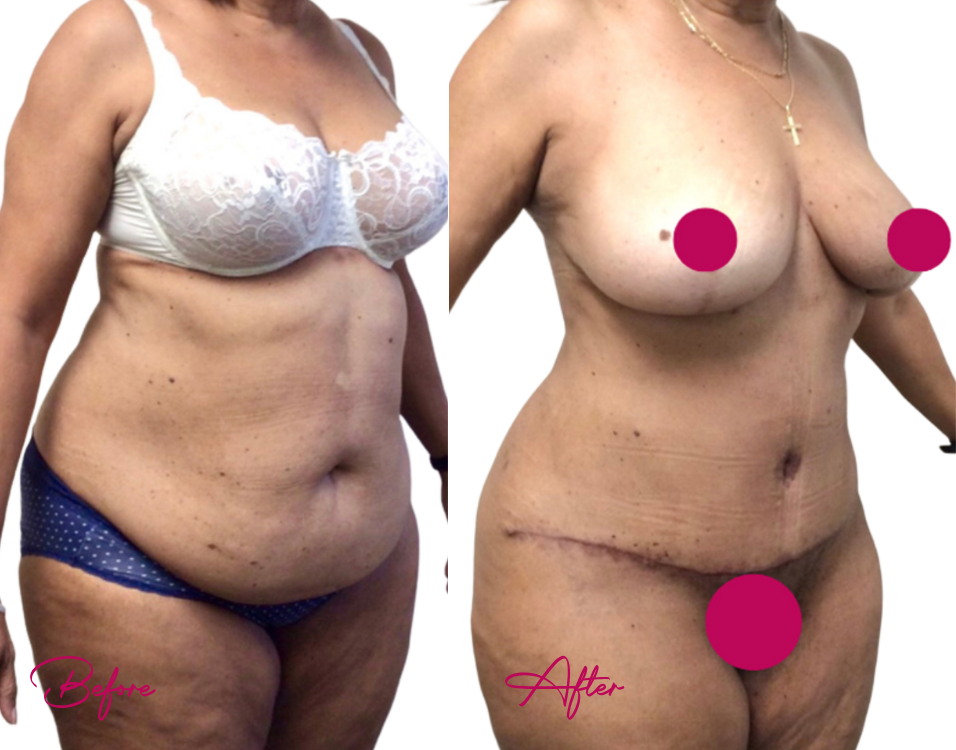 Tummy Tuck Case 26