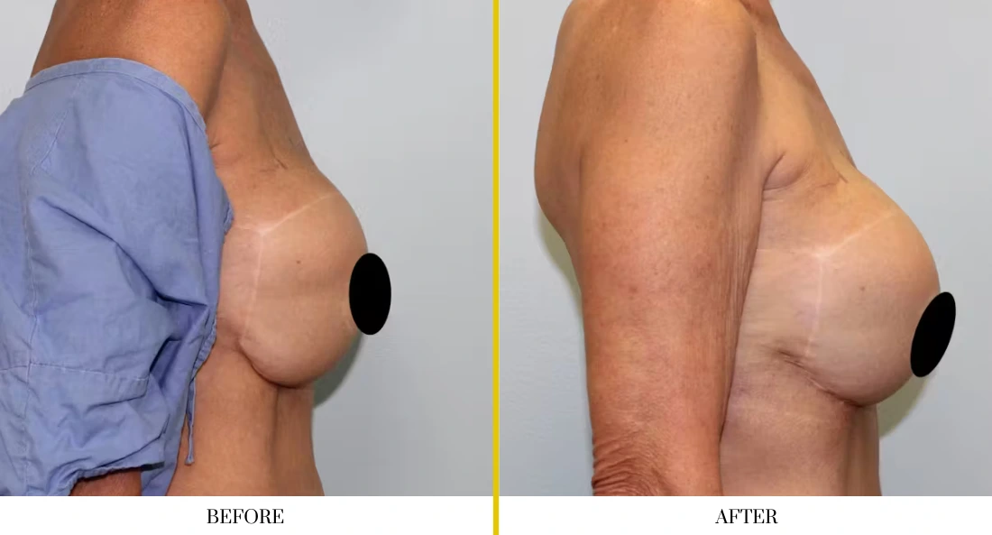 BREAST RECONSTRUCTION (13)