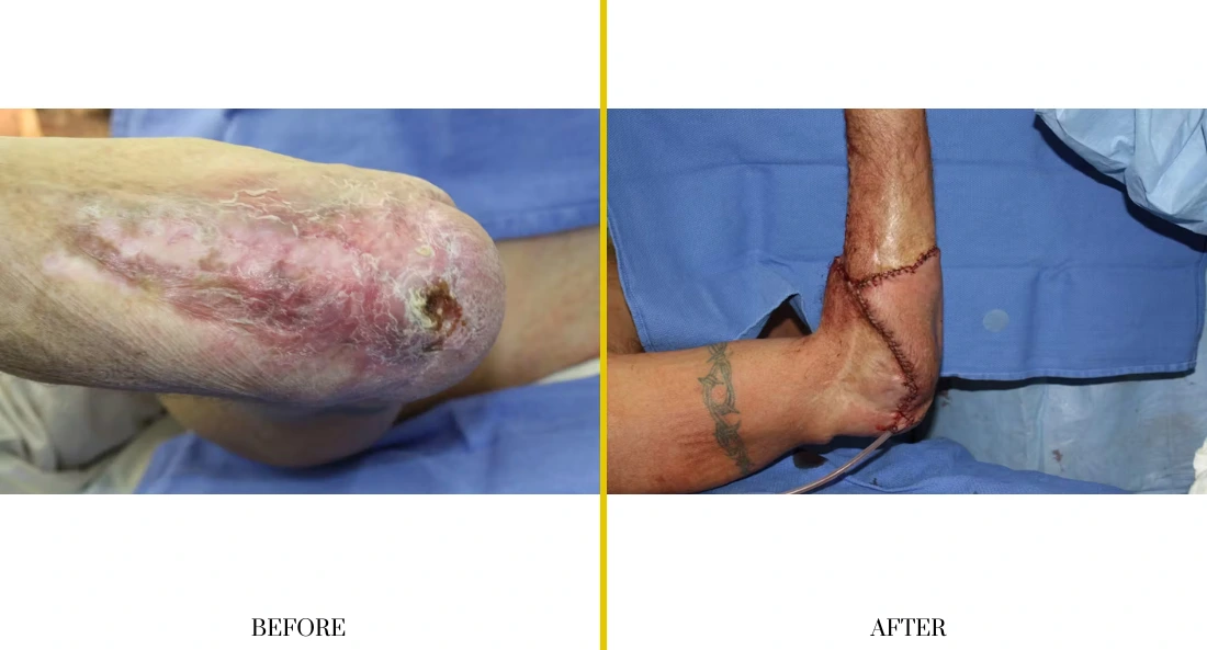 Extremity Reconstruction (1)
