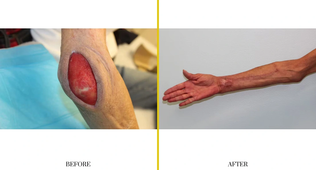 Extremity Reconstruction (10)