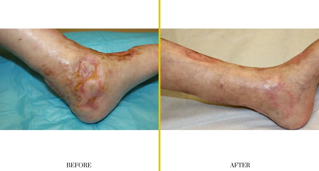 Extremity Reconstruction (14)