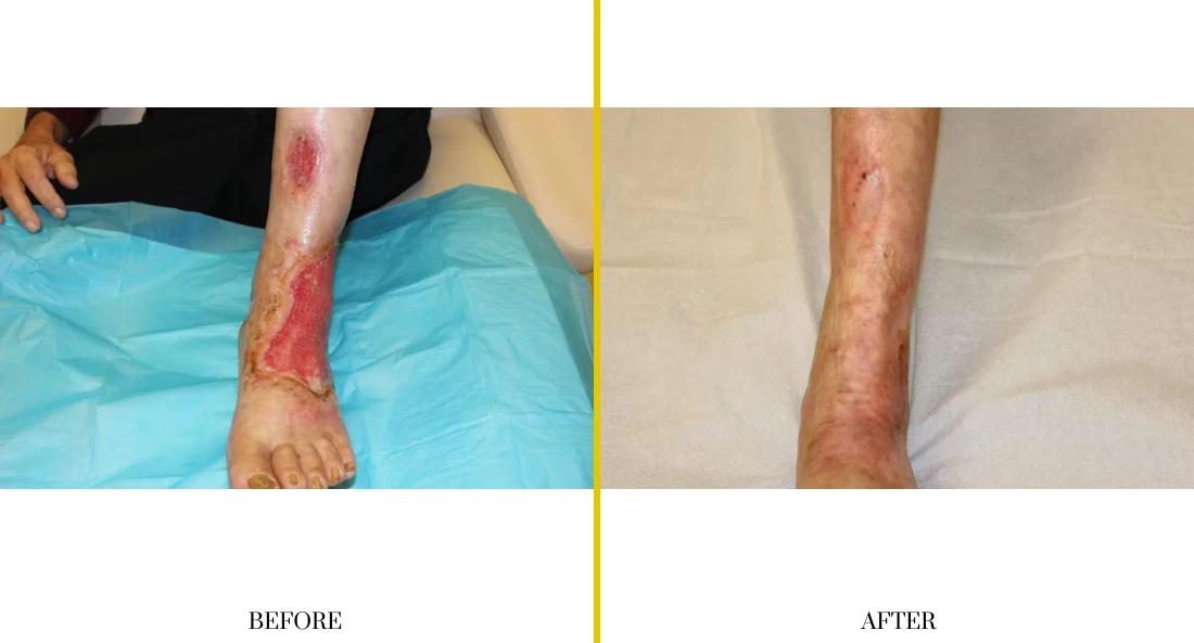 Extremity Reconstruction (16)