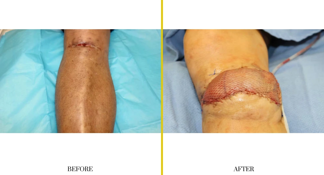 Extremity Reconstruction (18)