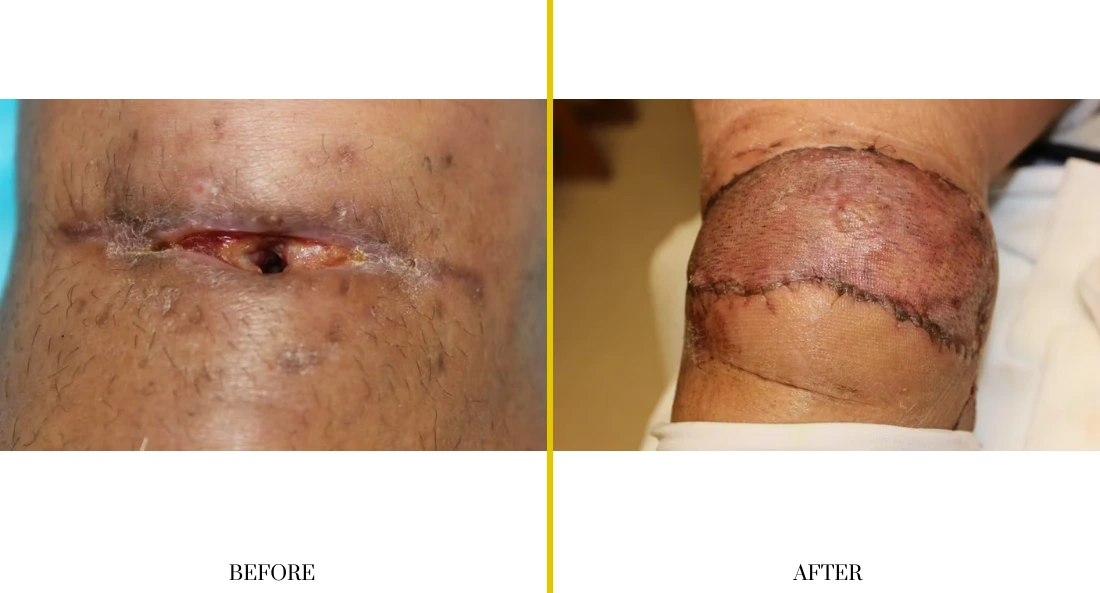 Extremity Reconstruction (19)