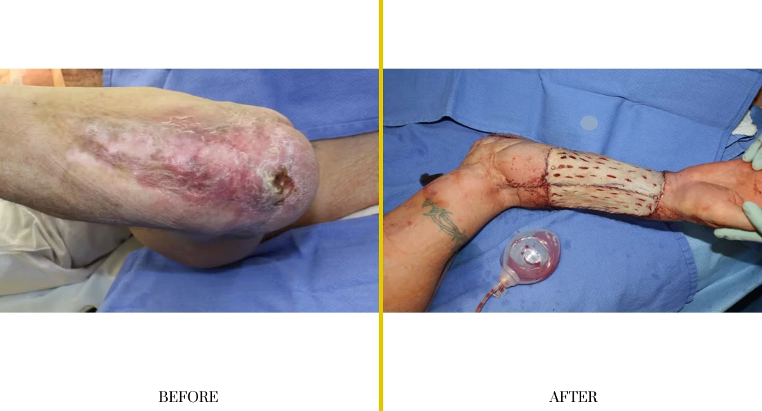 Extremity Reconstruction (2)