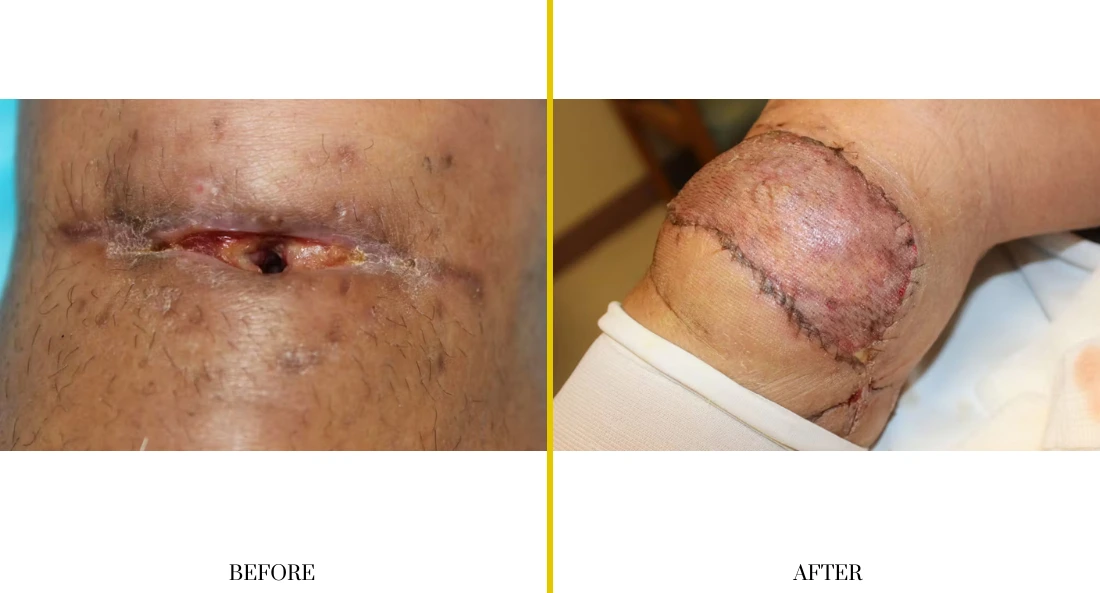 Extremity Reconstruction (20)