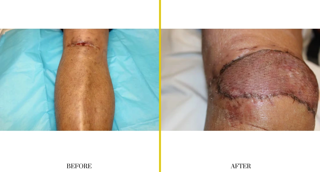 Extremity Reconstruction (21)