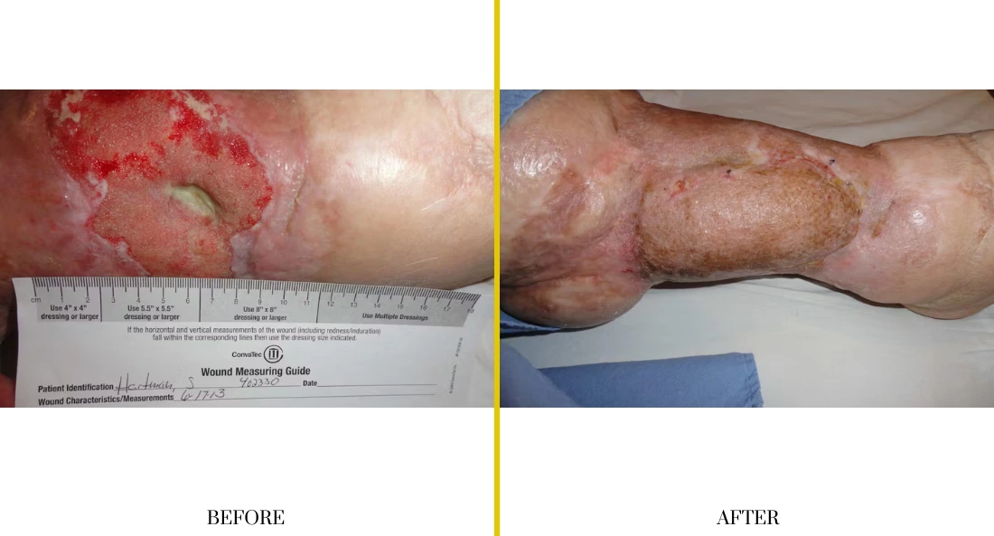 Extremity Reconstruction (22)