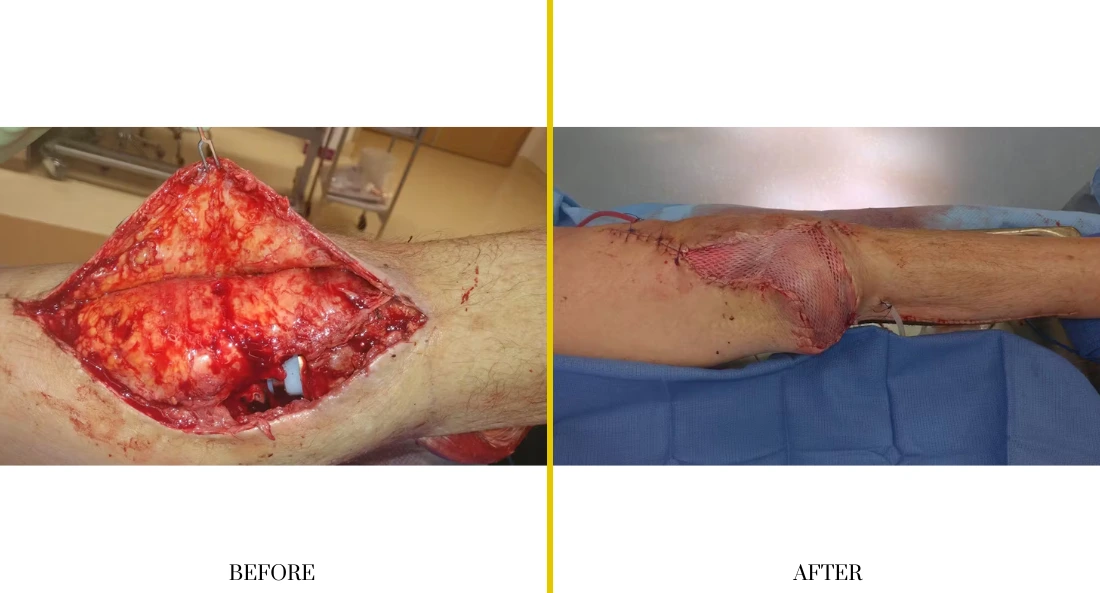 Extremity Reconstruction (28)