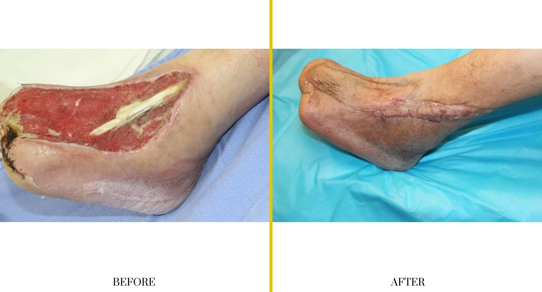 Extremity Reconstruction (3)