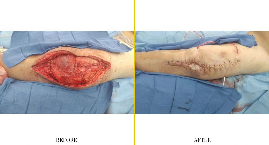 Extremity Reconstruction (35)