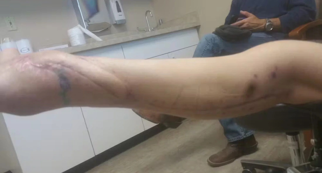 Extremity Reconstruction (51)