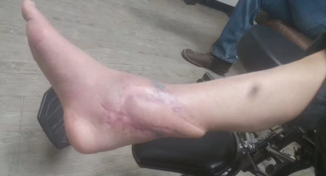 Extremity Reconstruction (52)