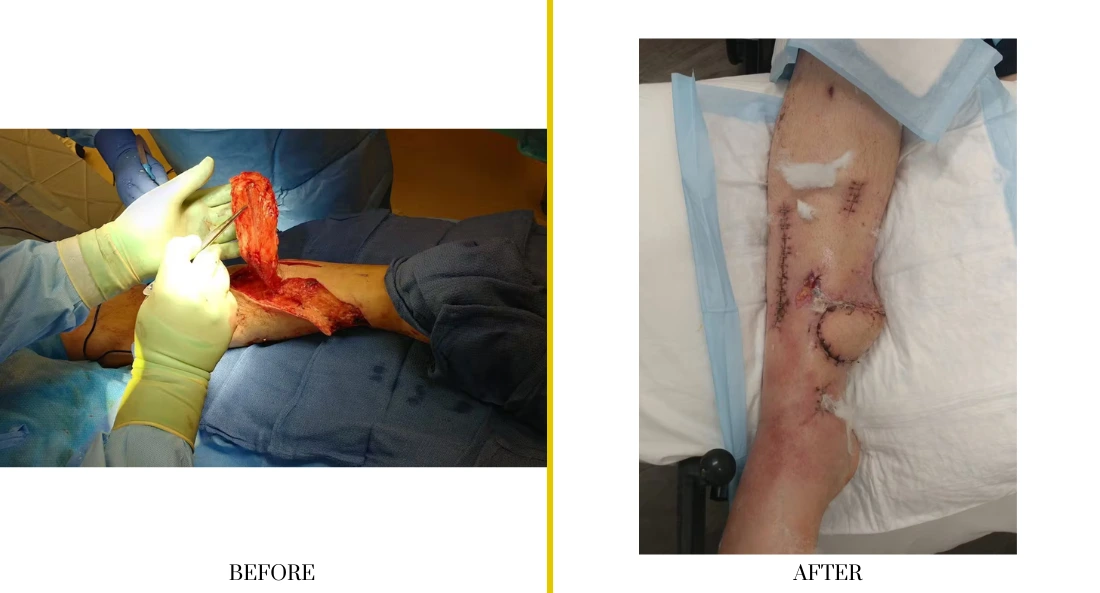 Extremity Reconstruction (53)