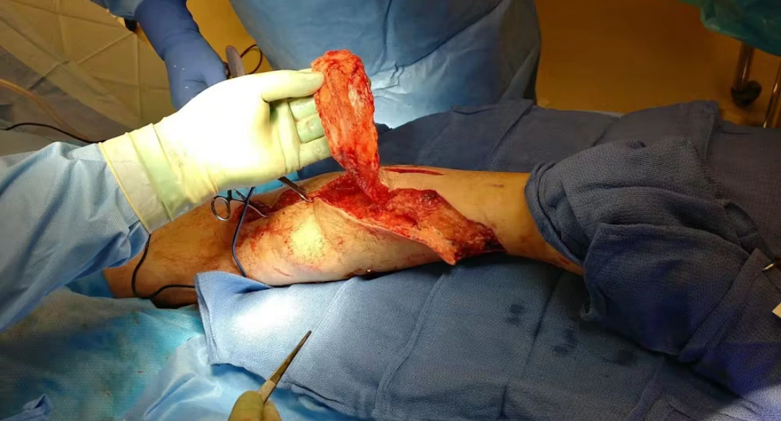 Extremity Reconstruction (54)