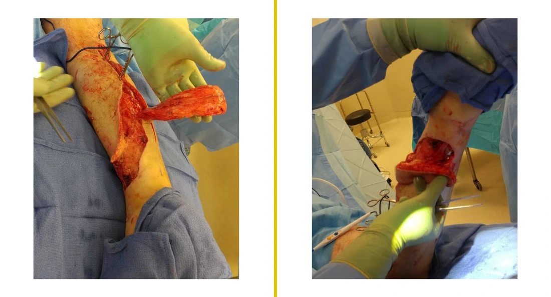 Extremity Reconstruction (55)