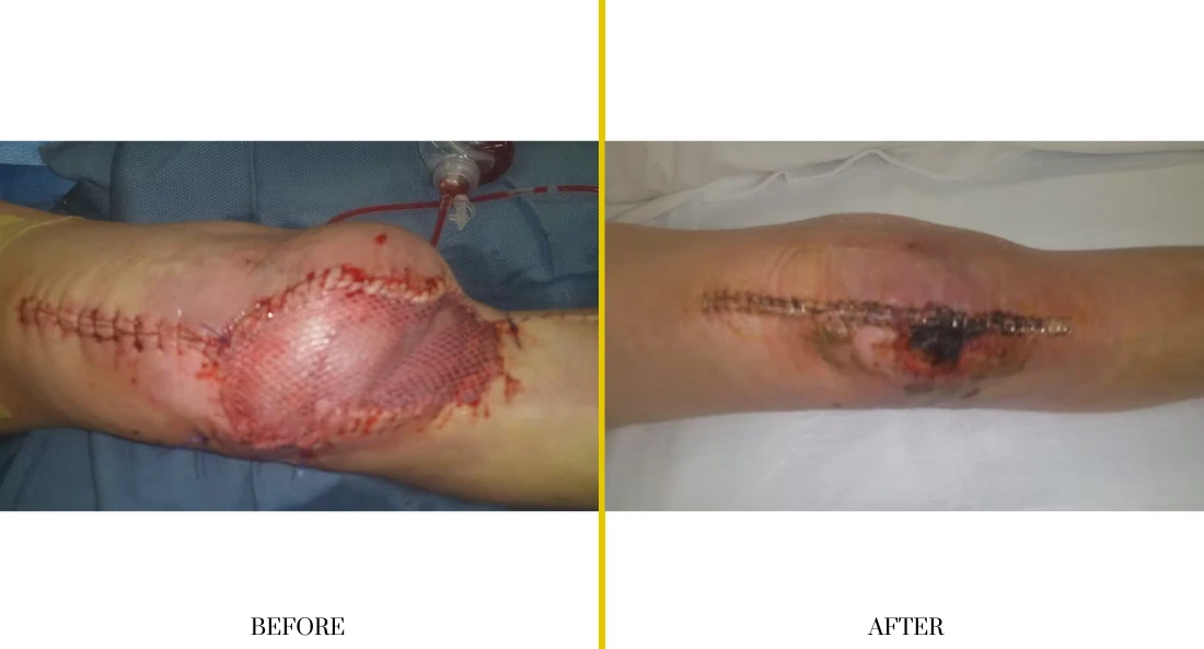 Extremity Reconstruction (56)