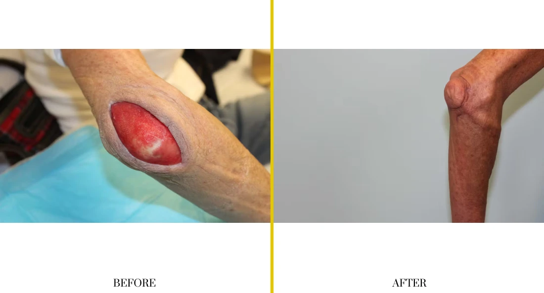 Extremity Reconstruction (8)