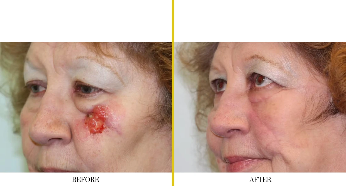 Facial and MOHS Reconstruction (1)