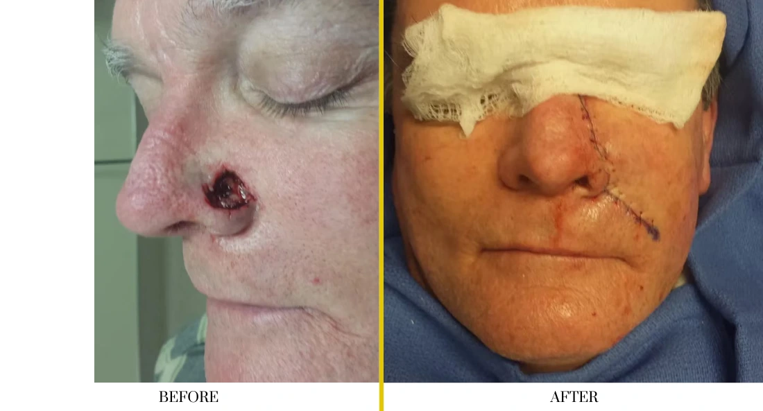 Skull Reconstruction and Cranioplasty (35)