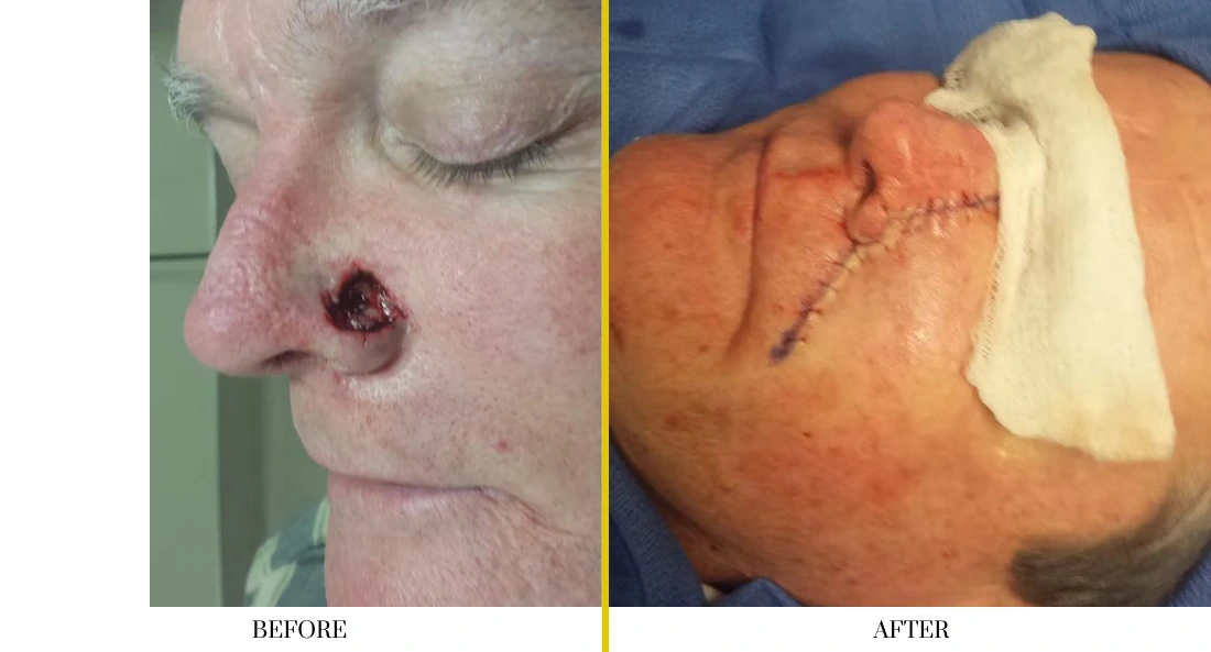 Skull Reconstruction and Cranioplasty (36)