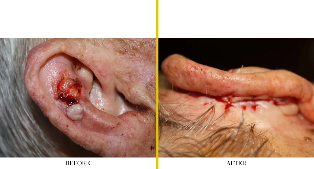 Skull Reconstruction and Cranioplasty (50)