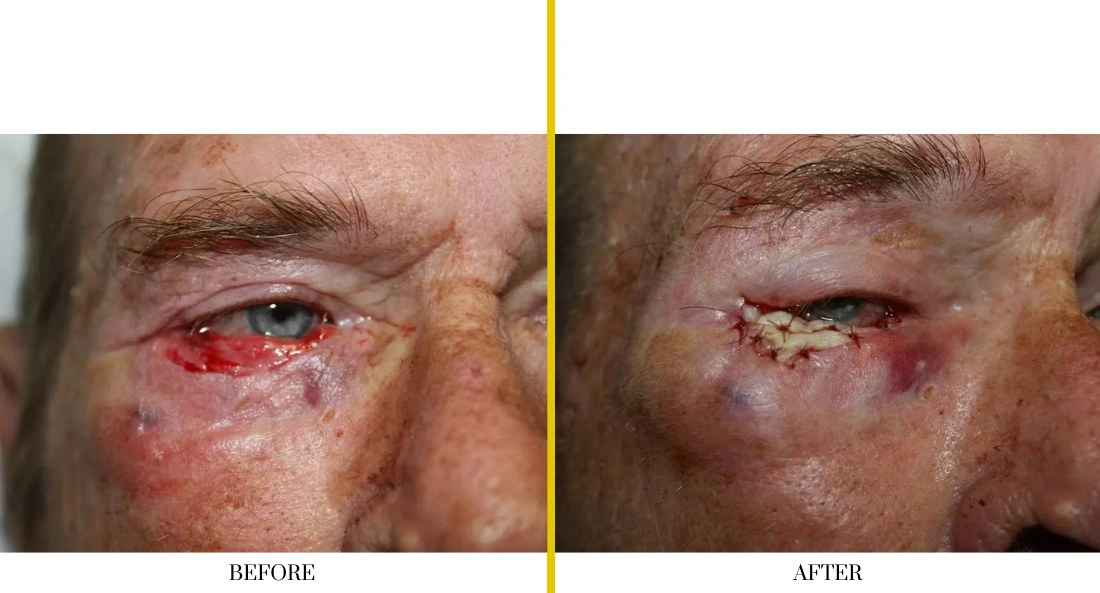 Skull Reconstruction and Cranioplasty (51)