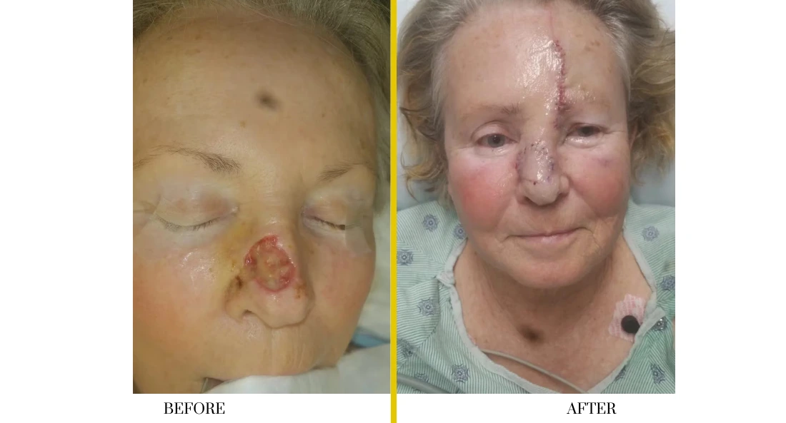 Skull Reconstruction and Cranioplasty (66)