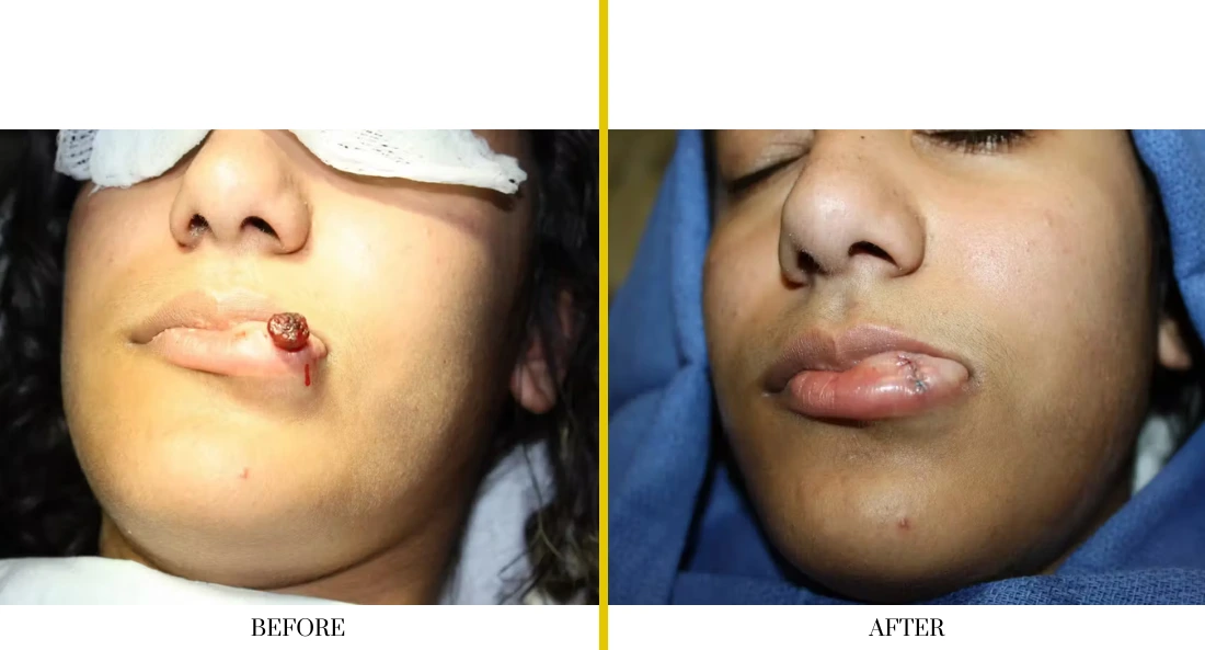 Skull Reconstruction and Cranioplasty (74)