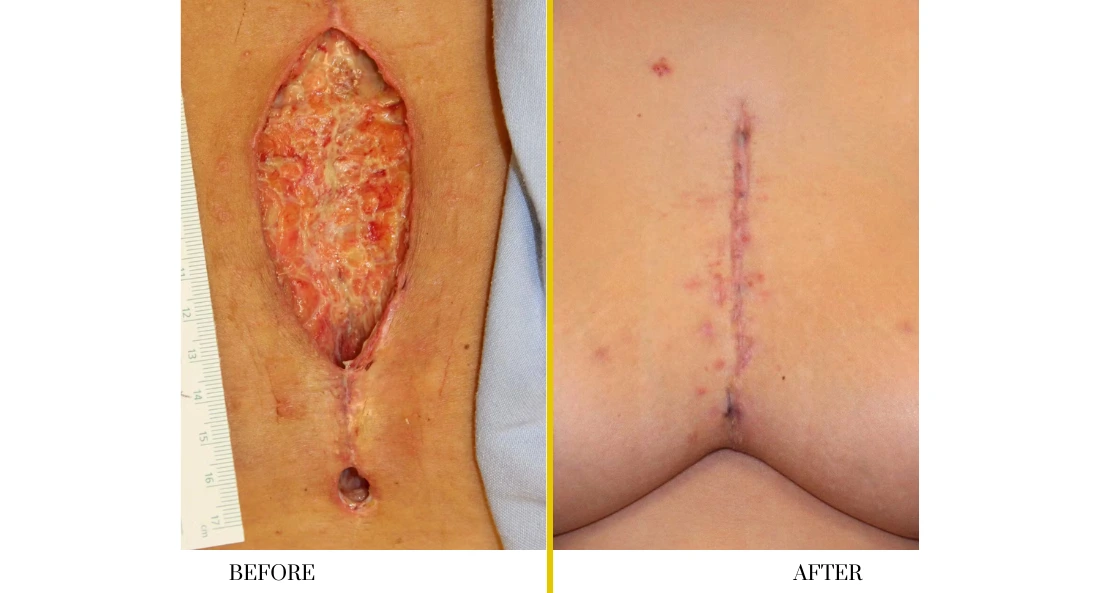Sternal Reconstruction