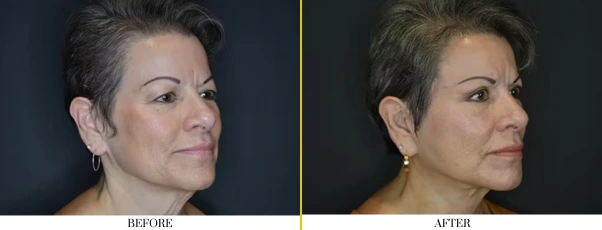 neck lift 1.1