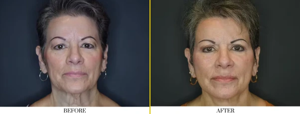 neck lift 1.2