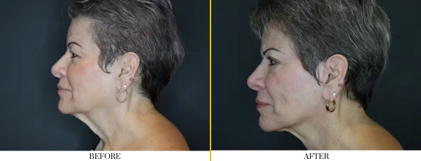 neck lift 1