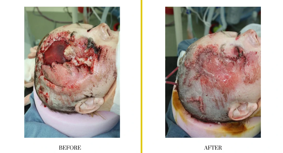 Extremity-Reconstruction-77