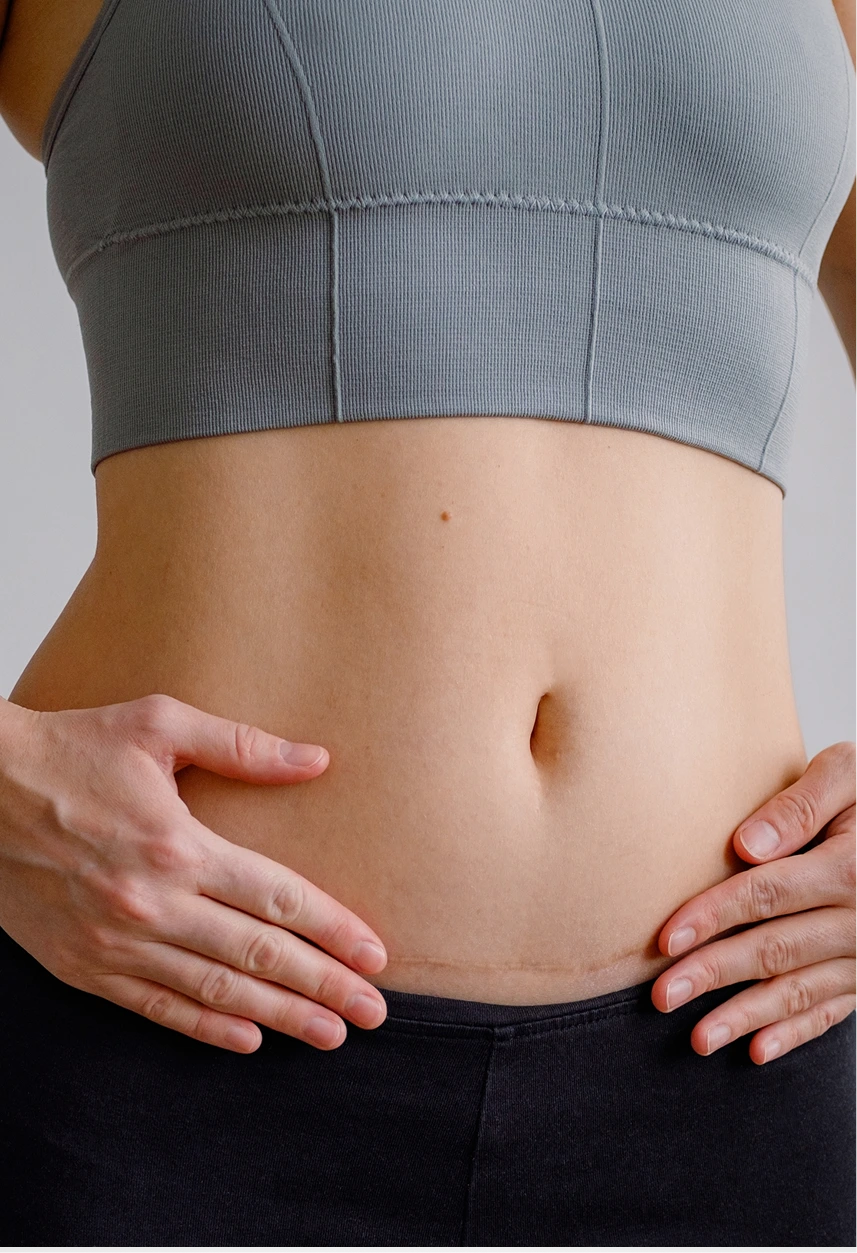 How to Minimize Tummy Tuck Scars Banner