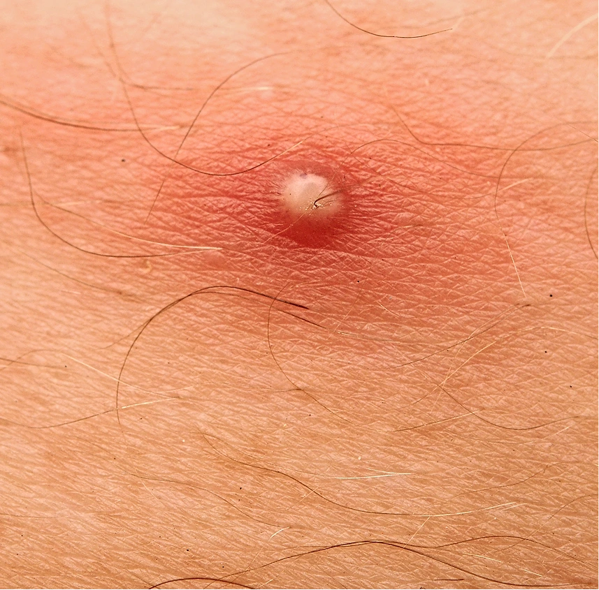 Candidates for Boil Treatment Banner