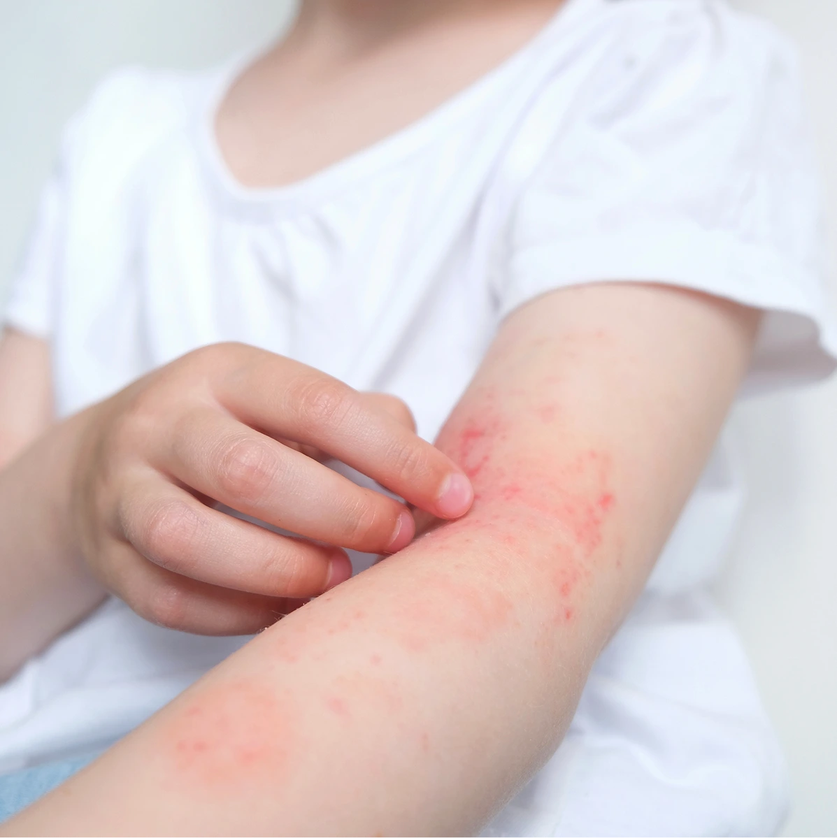 Eczema Treatment Phoenix, AZ Banner